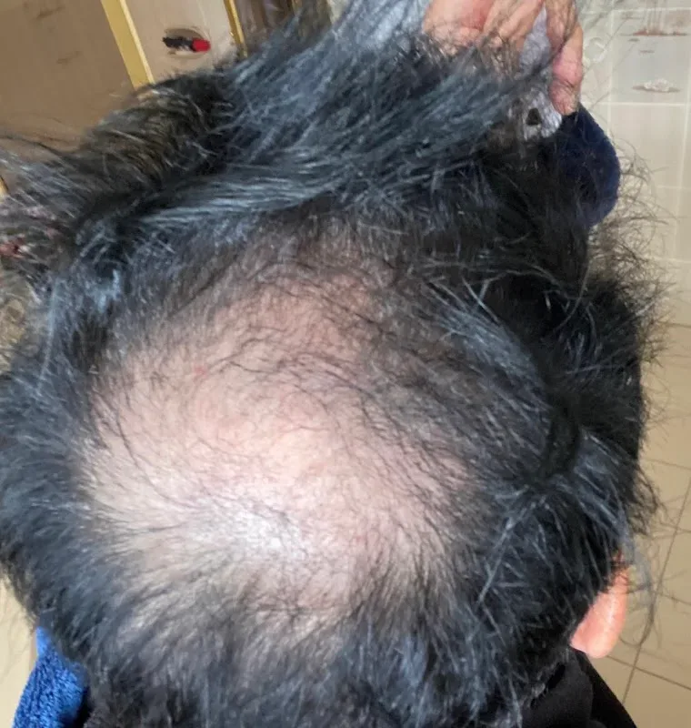 Scalp Ink — Hair replacement service in Nunawading